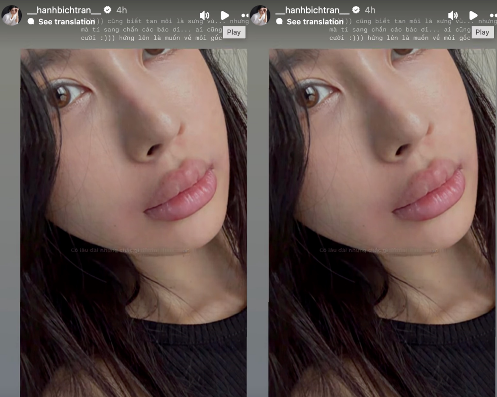 Thực tế, bạn gái của hậu vệ tuyển Việt Nam nhiều lần công khai việc thực hiện phương pháp thẩm mỹ không xâm lấn để duy trì vẻ ngoài trẻ trung và sắc nét.