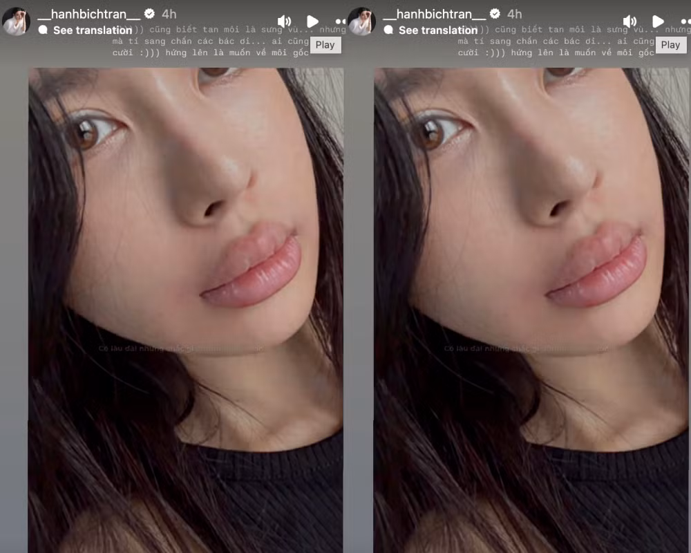 Thực tế, bạn gái của hậu vệ tuyển Việt Nam nhiều lần công khai việc thực hiện phương pháp thẩm mỹ không xâm lấn để duy trì vẻ ngoài trẻ trung và sắc nét.