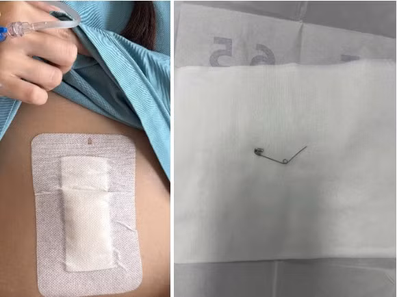 Phía dưới chia sẻ của Vân Anh, nhiều người bất ngờ và bày tỏ sự khó hiểu vì chiếc kim băng để mở, khi nuốt sẽ dễ bị vướng lại hoặc làm rách thực quản.