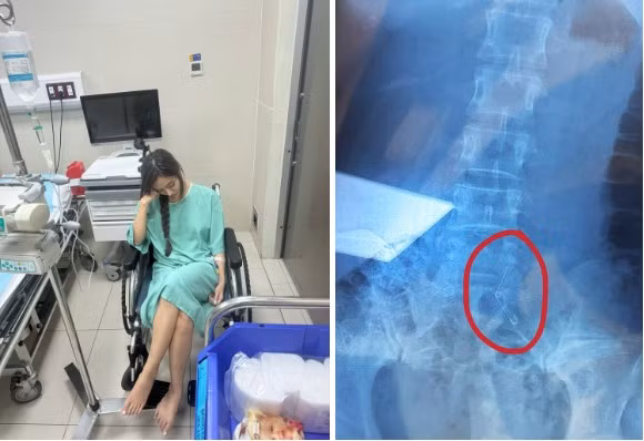 Sau đó Vân Anh được đưa đi cấp cứu và mất 6 tiếng để mổ lấy kim băng ra.