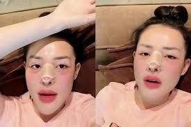 Ngân 98 đã phải phẫu thuật tháo mũi và cho biết rất đau lớn, thậm chí bị ngất xỉu: "Cái mũi tôi làm lần này sau rất đau. Hôm bữa tôi truyền thuốc không nổi luôn, về nhà xỉu luôn. Trong vòng 1 tháng tôi bị lấy mất hai khúc sườn. Lấy 2 lần luôn, giờ tôi bị hai cái sẹo".