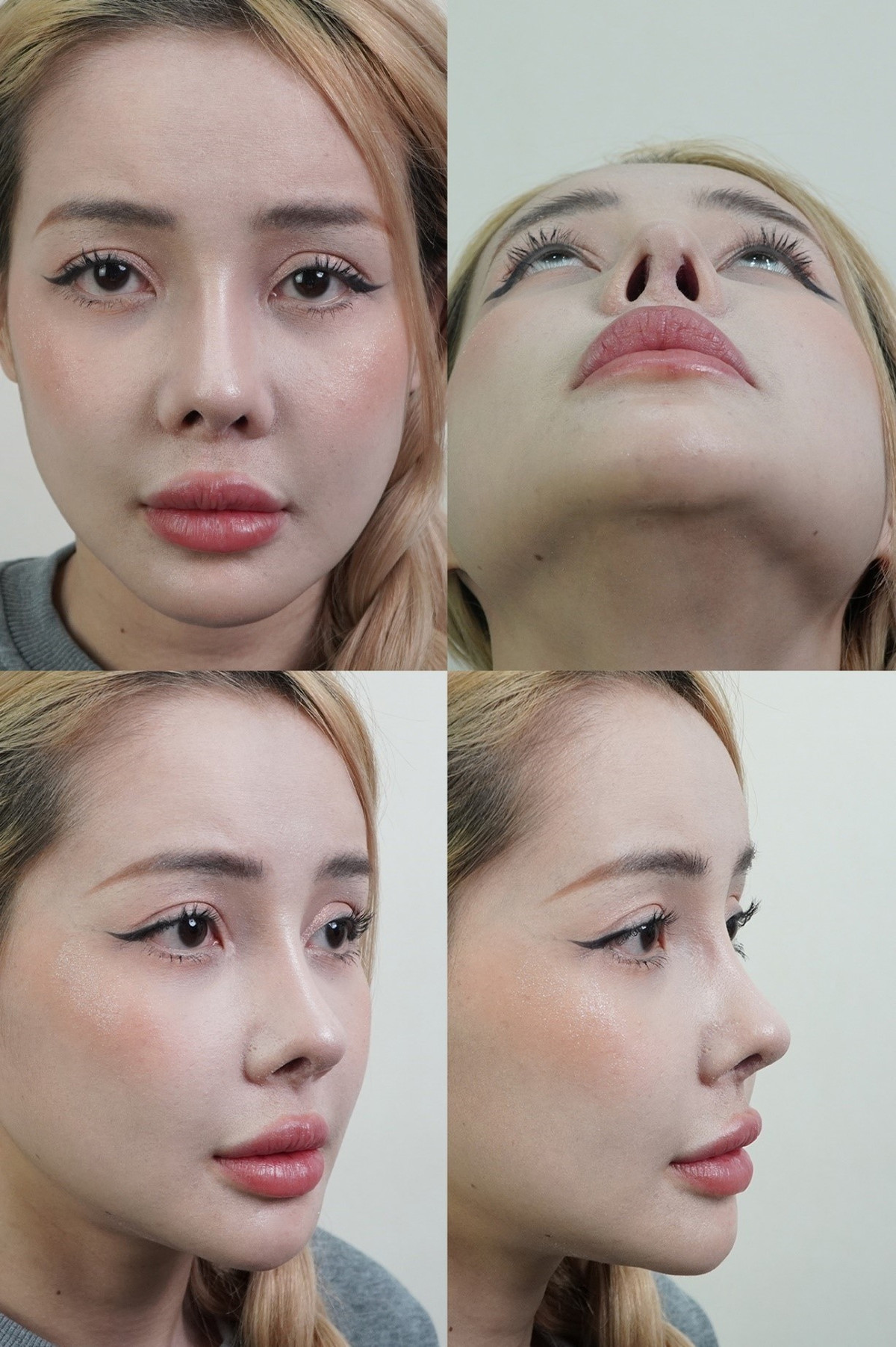 Khác với nhiều sao Việt giấu kín bưng chuyện phẫu thuật thẩm mỹ, cô lại thoải mái công khai chia sẻ việc "dao kéo". Ngân 98 từng đưa ra quan điểm: "Tôi luôn thích chia sẻ mọi thứ về mình cho mọi người biết. Mọi thứ tôi chia sẻ đều là những gì tôi trải nghiệm trong cuộc sống của chính mình". Ảnh sử dụng trong bài: FBNV