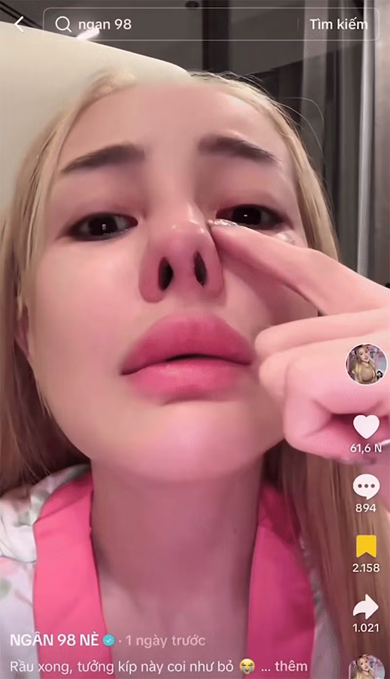 Hình ảnh Ngân 98 sau khi phẫu thuật thẩm mỹ lỗi.