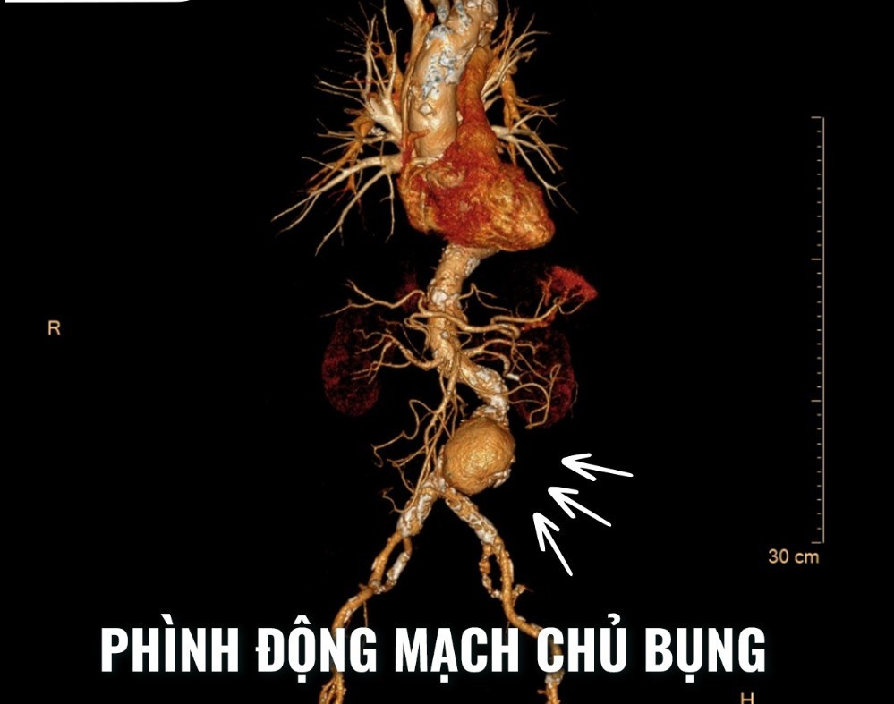 phinh-dong-mach-chu-bung-3.jpg