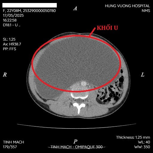 Khối u buồng trứng khổng lồ trên phim chụp - Ảnh BVCC