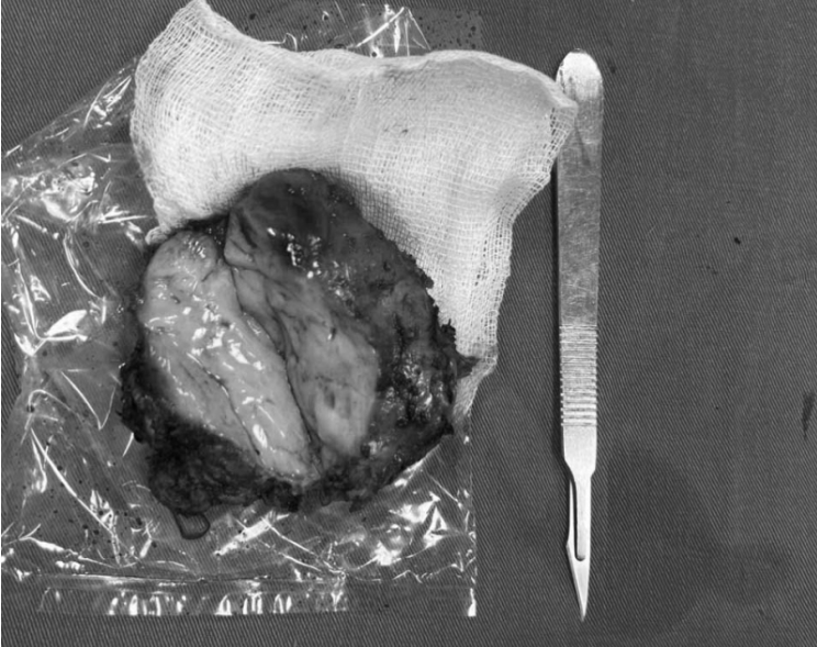 Khối u tuyến giáp được cắt bỏ - Ảnh BVCC