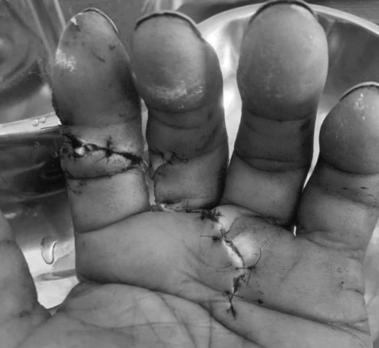 Ngón tay của bệnh nhân được phục hồi sau phẫu thuật - Ảnh BVCC