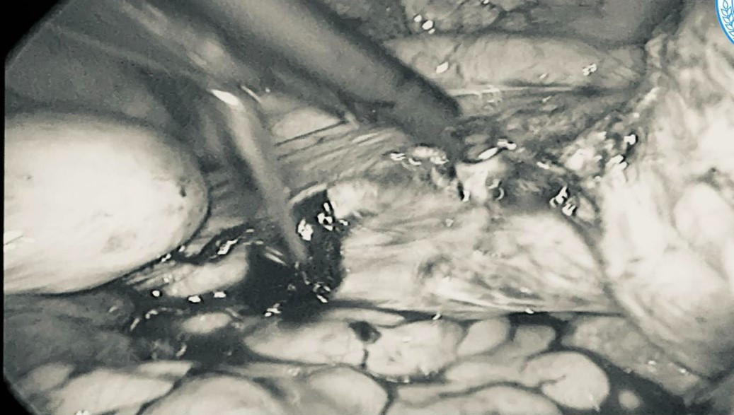 Hình ảnh khối u kích thước lớn qua nội soi - Ảnh BVCC