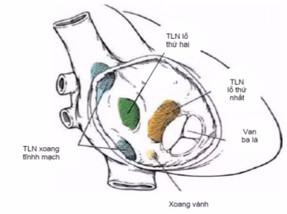 Biểu hiện của thông liên nhĩ - Ảnh minh họa BVCC