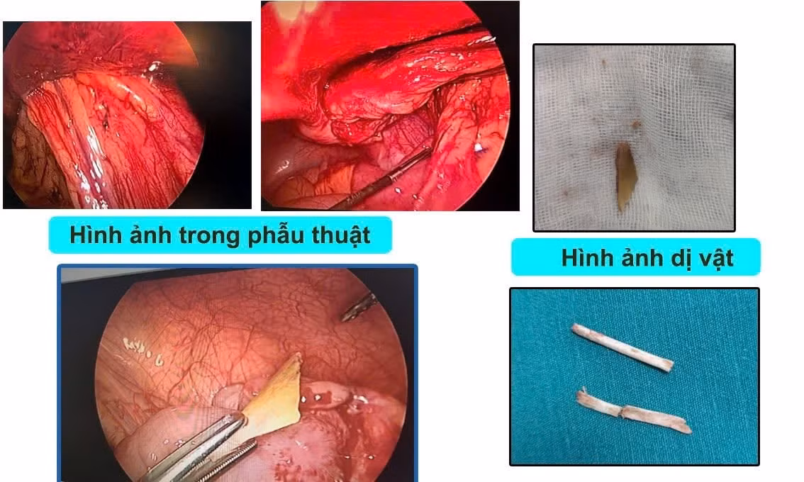 thung-ruot.jpg