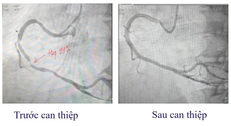 Hình ảnh mạch máu trước và sau can thiệp - Ảnh BVCC nhoi-mau-st1.jpg