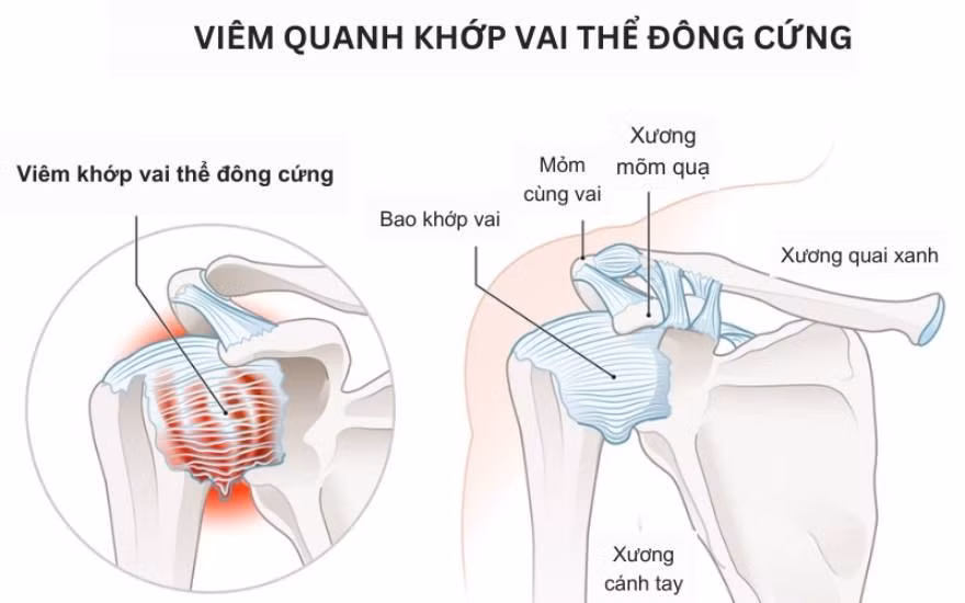 dong-cung-khop-vai-1.jpg