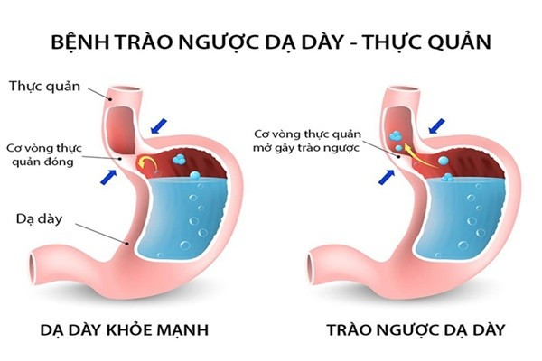 trao-nguoc.jpg