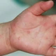 Phòng tránh bệnh tay chân miệng mùa cao điểm
