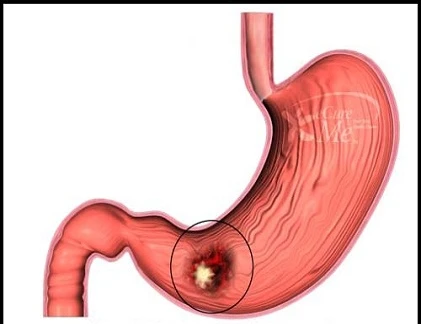 9 câu hỏi trắc nghiệm bạn có nguy cơ mắc ung thư