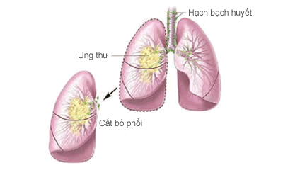 Nghiên cứu mới giúp các bệnh nhân tránh được các xạ trị không cần thiết, cũng như chứng minh rằng những ca tử vong ung thư phổi là do nhiều nguyên nhân khác liên quan.