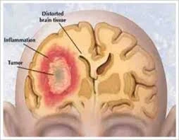 Hạt nano từ tính có thể chữa khỏi ung thư