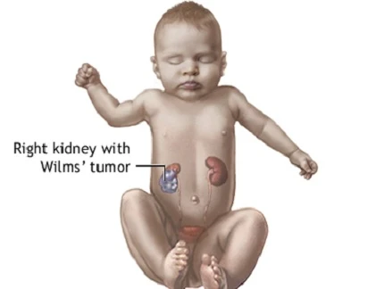 7 dạng ung thư ác tính thường gặp ở trẻ em 