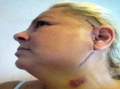 Người phụ nữ cấy ghép hàm titan 16.000 bảng Anh