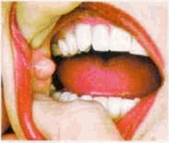 2. Khối u: Các khối u có thể gây đau đớn và thường tạo thành dưới răng, trên nướu răng. Các khối u phát triển trên đường viền hàm dưới cũng có thể gây đau răng.