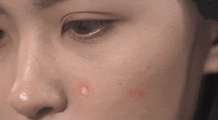 Mảng đỏ trên mặt, cẩn thận bệnh trứng cá đỏ