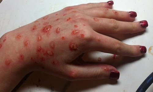 Top bệnh truyền nhiễm dễ bùng phát khi Hà Nội vào hè