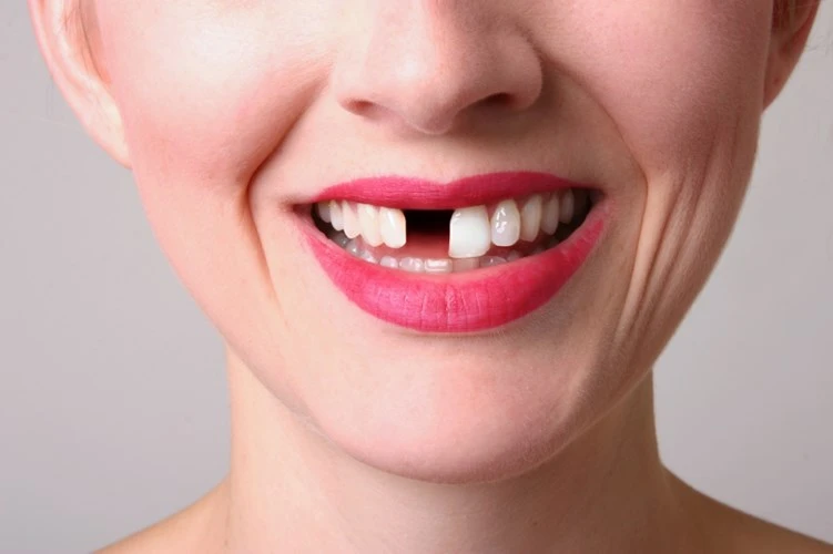 Những thói quen nguy hại khiến răng biến dạng khủng khiếp