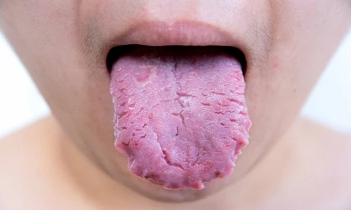 Chuẩn đoán sức khỏe qua tình trạng của lưỡi