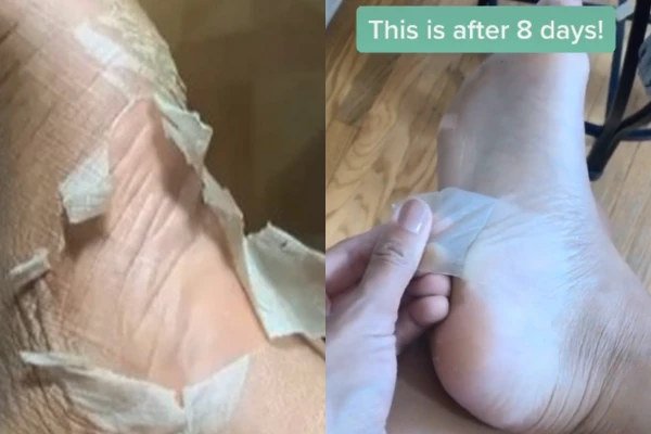 Trào lưu lột da chân trên Tik Tok: 1001 trò lố của teen Việt