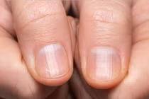 Thay đổi nhỏ ở móng tay có thể cảnh báo bệnh tiềm ẩn