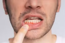 Kẹo dẻo lợi khuẩn giúp giảm chảy máu chân răng chỉ sau 6 tuần