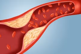 Ăn gì để giảm cholesterol xấu, bảo vệ tim mạch? 
