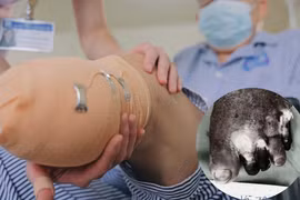 Ngâm chân nước nóng, người đàn ông đái tháo đường suýt mất mạng