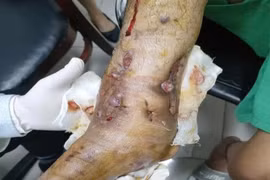 Suýt phải cắt chân sau nhiều lần phẫu thuật vì bỏ sót lao xương