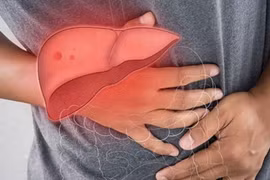 Sau nút mạch hóa chất u gan, chăm sóc đúng giảm biến chứng