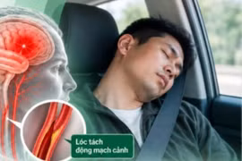 Ngủ sai tư thế, người đàn ông 40 tuổi đột quỵ vì lóc tách động mạch cảnh