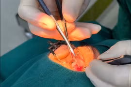 Nhiều ca mộng thịt nặng được xử lý, cẩn trọng nguy cơ bệnh nền