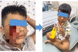 Cấp cứu trẻ 5 tuổi bị chó cắn rách nát mặt phải
