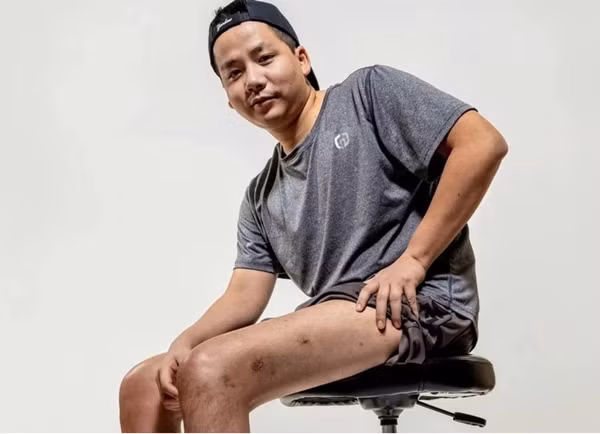 Cách đây vài năm, Khoa Pug đã thực hiện ca phẫu thuật kéo chân tại Mỹ để cao từ 1m6 lên 1m7. Ảnh: Internet