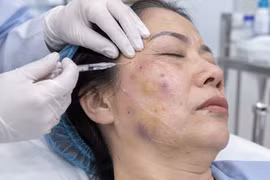 Biến chứng nguy hiểm sau nhiều năm tiêm filler không rõ nguồn gốc
