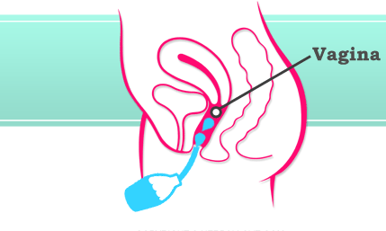 Đã có nhiều nghiên cứu chứng minh thụt rửa vùng kín hoặc vệ sinh vùng kín bằng dụng cụ vệ sinh sẽ dẫn đến các nhiễm do nấm men, viêm khung xương chậu và mang thai ngoài tử cung. Các nhà nghiên cứu còn phát hiện ra mối liên hệ giữa thụt rửa vùng kín với ung thư buồng trứng, giảm khả năng sinh sản, HIV và một số bệnh lây nhiễm qua đường tình dục khác. 
