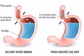 Phòng ngừa biến chứng của bệnh trào ngược dạ dày thực quản