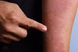 Chăm sóc viêm da cơ địa mùa lạnh