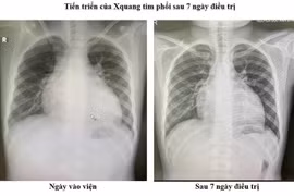 Điều trị thành công ca bệnh suy tim nặng ở trẻ em theo phác đồ mới 