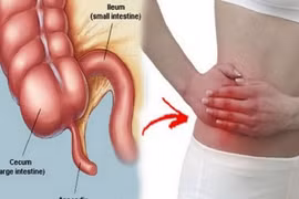 Chủ quan đau bụng kéo dài, người đàn ông 36 tuổi bị vỡ ruột thừa nguy kịch