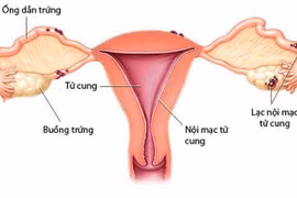 Lạc nội mạc tử cung ảnh hưởng đến khả năng sinh sản thế nào?