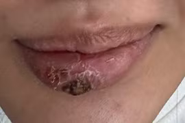 Một thiếu nữ bị biến dạng môi nghiêm trọng do tiêm filler tại spa
