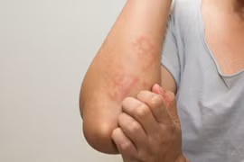 Mùa mưa làm tăng nguy cơ nhiễm ký sinh trùng từ chó, mèo
