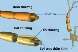  Người đàn ông ở Đắk Lắk mắc hội chứng hiếm Guillain-Barré