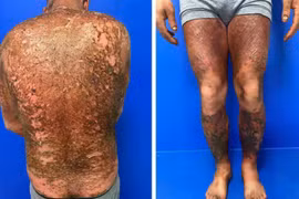 Da tổn thương nặng vì tự ý bỏ thuốc vảy nến, đắp "cao thảo dược truyền miệng"